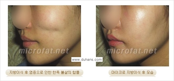 [두한성형외과 경쟁력 미세지방이식] - [미세지방이식 부작용 종류와 교정방법 안내] 관련 이미지 4