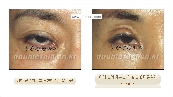 [두한성형외과 경쟁력 쌍꺼풀 재수술, 극한 눈재수술] - [쌍꺼풀 재수술, 극한 눈재수술 관련 자주하는 질문과 답변] 관련 이미지 2
