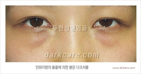 [두한성형외과 경쟁력 눈밑성형] - [눈밑 안와지방 돌출의 무통마취 무흉터 눈밑지방제거 안내] 관련 이미지 1