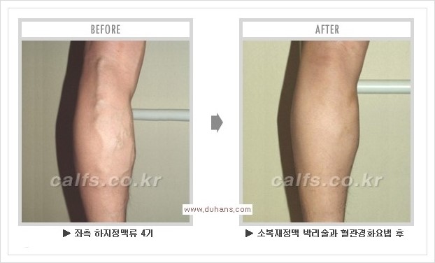 [두한성형외과 경쟁력 멀티종아리성형] - [종아리성형 방법별 전후 주의사항] 관련 이미지 35