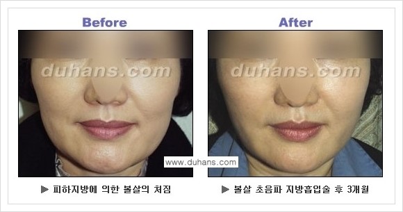 [두한성형외과 경쟁력 지방흡입] - [볼살지방흡입 안내] 관련 이미지 10