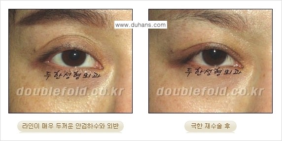 [두한성형외과 경쟁력 쌍꺼풀 재수술, 극한 눈재수술] - [망친 쌍꺼풀을 복원하는 극한 눈재수술] 관련 이미지 3