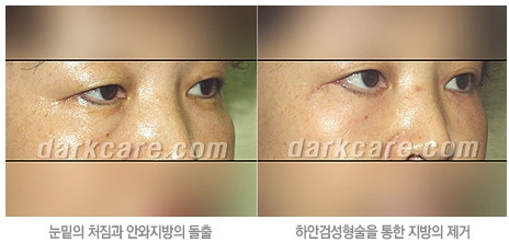 [두한성형외과 눈밑성형] - [무흉터 눈밑지방제거] 관련 이미지 9