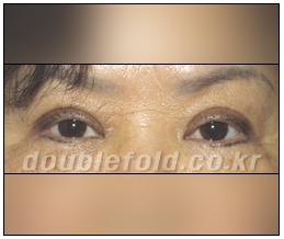 [Duhan Plastic Surgery Reoperation for Double Eyelids] - [Lowering the Double Eyelid Line] image 3