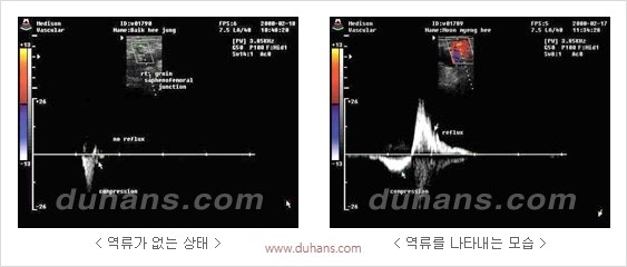 [두한성형외과 경쟁력 정맥류 치료] - [정맥류 치료의 모든 것] 관련 이미지 4