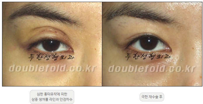 [Duhan Plastic Surgery Double Eyelid Revision] - [Thick Double Eyelid Line] image 37