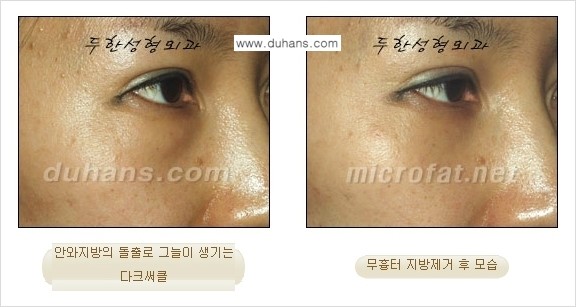 [두한성형외과 젊은 눈매 안검성형] - [눈밑 지방제거의 수술 전후 안내 ①] 관련 이미지 19