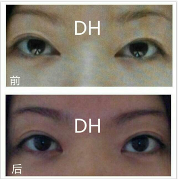 쌍커풀수술 두한성형외과 - 나에게 맞는 눈성형은? 관련 이미지 61