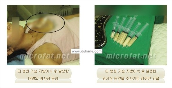 [두한성형외과 경쟁력 지방이식] - [지방이식 부작용 교정 안내 1.] 관련 이미지 11