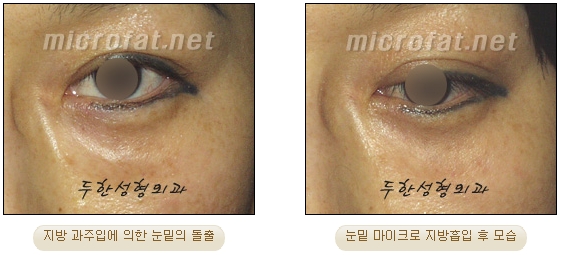 [Duhan Plastic Surgery Liposuction] - [Facial Liposuction] image 36