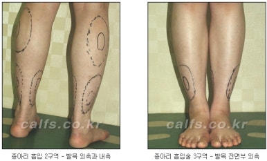 [두한성형외과 종아리수술] - [종아리 비만의 정교한 미세흡입관 지방흡입술] 관련 이미지 4