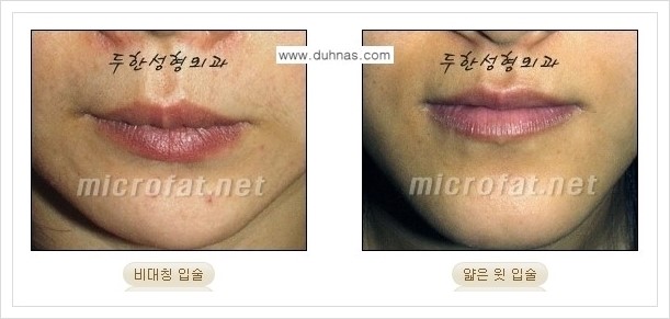 [두한성형외과 경쟁력 미세지방이식] - [입술 미세지방이식 안내 1.] 관련 이미지 1