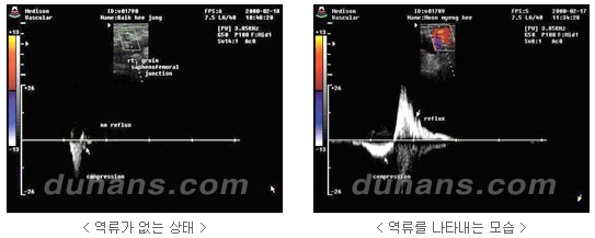 [두한성형외과 정맥류] - [하지정맥류, 정맥확장증, 혈관확장증] 관련 이미지 4