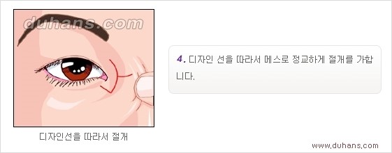 [두한성형외과 경쟁력 눈성형] - [흉터없는 몽고주름 제거 - 앞트임 수술 안내] 관련 이미지 12