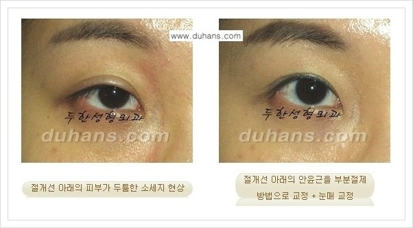 [두한성형외과 경쟁력 쌍꺼풀 재수술(극한 재수술)] - [절개선 아래가 두툼한 소세지 현상 안내] 관련 이미지 7