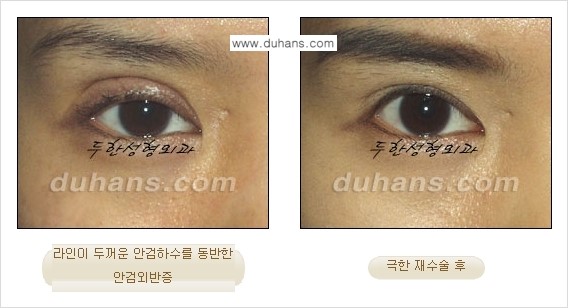 ⁠⁠⁠⁠[두한성형외과 성형 FOCUS] - [정상적인 눈매로의 복원 극한재수술 경우 ①] 관련 이미지 9