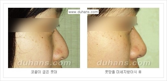 [두한성형외과 경쟁력 코성형] - [자연스러운 코 미세지방이식] 관련 이미지 6