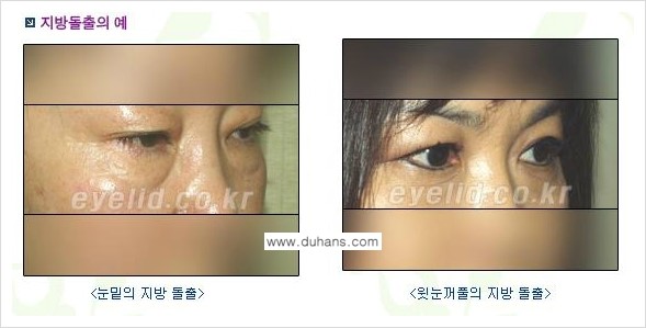 [두한성형외과 NO.1 눈성형] - [눈꺼풀 지방제거 관련 흔한 질문과 답변] 관련 이미지 1