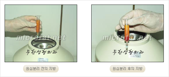 [두한성형외과 경쟁력 안티에이징 동안성형] - [주름이 깊은 푹~ 꺼진 입가 팔자주름 안녕!] 관련 이미지 11