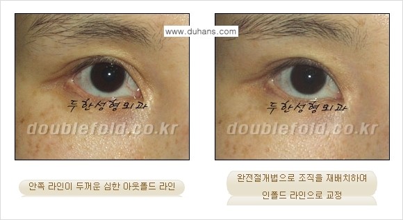 [두한성형외과 경쟁력 쌍꺼풀 재수술, 극한 눈재수술] - [심한 아웃폴드 라인을 인폴드 라인으로 교정 방법 안내] 관련 이미지 10