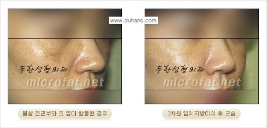 [두한성형외과 경쟁력 귀족성형] - [3차원 입체 미세지방이식 귀족수술 + 인디언밴드 교정] 관련 이미지 14