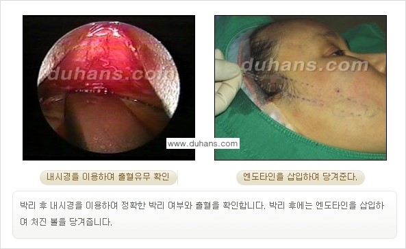 [두한성형외과 젊어지는 주름교정술] - [주름제거 시술방법 ②] 관련 이미지 10