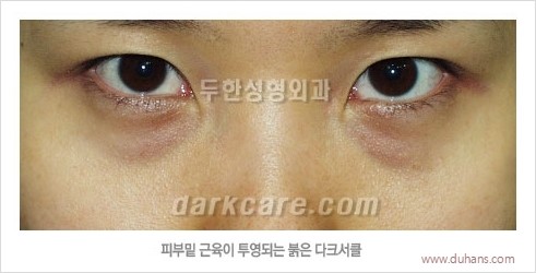 [두한성형외과 경쟁력 눈밑성형] - [다크써클의 원인과 다크써클의 종류] 관련 이미지 14