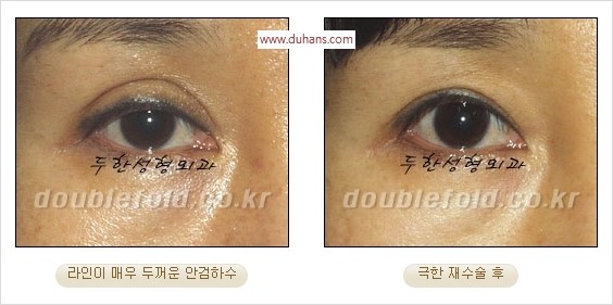 [두한성형외과 경쟁력 쌍꺼풀 재수술] - [두꺼운 라인을 교정하는 극한 재수술(Extreme Rroperation)] 관련 이미지 23