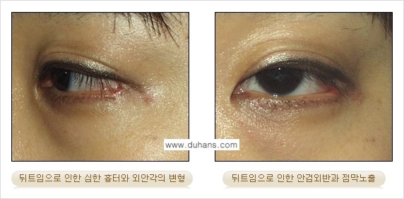[두한성형외과 경쟁력 눈성형] - [뒤트임 수술 부작용 안내] 관련 이미지 5