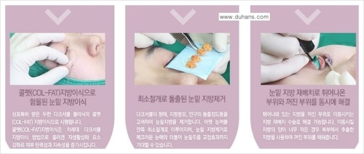 [두한성형외과 경쟁력 다크써클 치료] - [다크써클 5단계로 이뤄지는 핵심 5 STEP SOLUTION 안내 1.] 관련 이미지 12