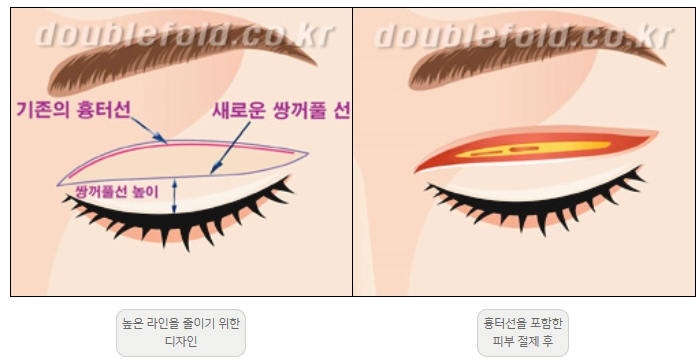 [Duhan Plastic Surgery Double Eyelid Revision] - [Thick Double Eyelid Line] image 3