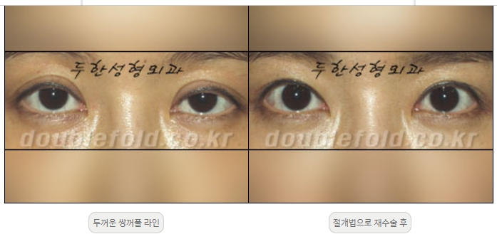 [Duhan Plastic Surgery Double Eyelid Revision] - [Thick Double Eyelid Line] image 9