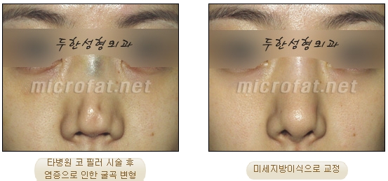 [Duhan Plastic Surgery Wrinkle Improvement] - [Wrinkle Filler Procedure] image 13