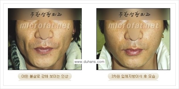 [두한성형외과 경쟁력 윤곽성형] - [볼, 볼살 지방이식] 관련 이미지 30