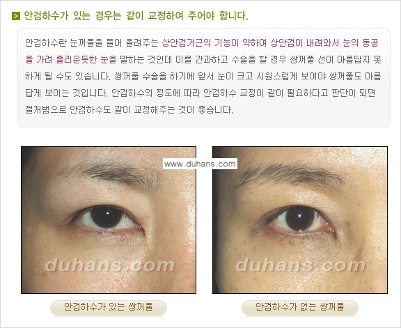 [두한성형외과 경쟁력 눈성형] - [매력적이고 아름다운 쌍꺼풀이란?] 관련 이미지 7