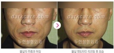 [눈밑수술 두한성형외과] - [다크서클 콤비프로그램] 관련 이미지 136