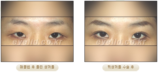 [Double Eyelid Surgery Duhan Plastic Surgery] - [Buried Method, Incision Method, Partial Incision Method] image 30