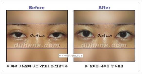 [두한성형외과 경쟁력 눈성형] - [안검하수(졸리운 눈매)의 종류와 교정 방법 안내] 관련 이미지 14