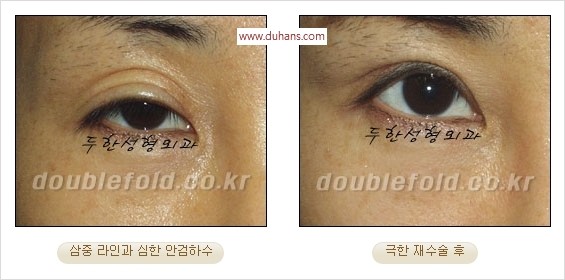 [두한성형외과 경쟁력 쌍꺼풀 재수술] - [두꺼운 라인을 교정하는 극한 재수술(Extreme Rroperation)] 관련 이미지 22