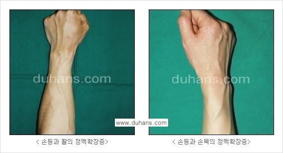 [두한성형외과 정맥 혈관 확장으로 인한 피부개선] - [손, 팔 혈관 확장] 관련 이미지 4