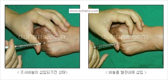[두한성형외과 경쟁력 정맥류 치료] - [정맥류 치료의 모든 것] 관련 이미지 29