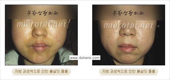 [두한성형외과 경쟁력 "미세지방이식"] - [미세지방이식의 잘못된 지식 1.] 관련 이미지 9