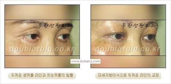 [두한성형외과 경쟁력 눈성형] - [쌍꺼풀 재수술 과정과 쌍꺼풀 재수술 실패의 원인, 쌍꺼풀 재수술의 성공 요건] 관련 이미지 33