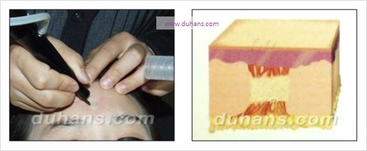 [두한성형외과 경쟁력 흉터성형] - [세가지 시술로 효과적인 함몰 흉터 교정] 관련 이미지 5