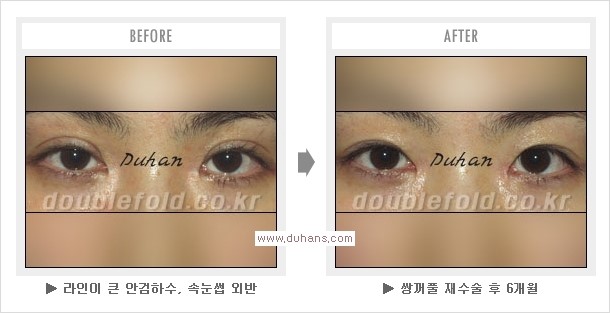 [두한성형외과 경쟁력 쌍꺼풀 재수술, 극한 눈재수술] - [망친 쌍꺼풀, 망가진 쌍꺼풀 복원수술, 재수술의 성공요건] 관련 이미지 6