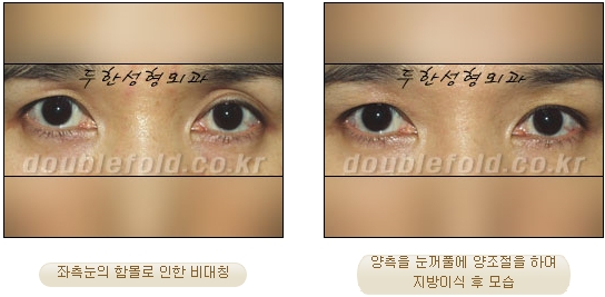 [Eye Reoperation Duhan Plastic Surgery] - [Guide to Double Eyelid Revision Surgery] image 60
