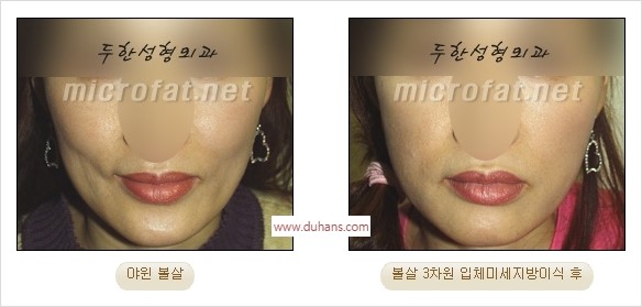 [두한성형외과 경쟁력 지방이식] - [두한 자가지방이식 클리닉 안내]​ 관련 이미지 41