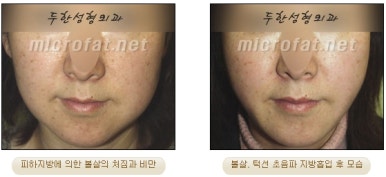 Facial Fat Liposuction at Duhan Plastic Surgery - Cheek Fat Liposuction, Jawline Liposuction, Under-Eye Fat Liposuction image 12