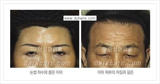 [두한성형외과 경쟁력 동안성형 리더] - ​[미간주름, 이마주름, 안검성형, 이마거상술, 눈썹거상술] 관련 이미지 39