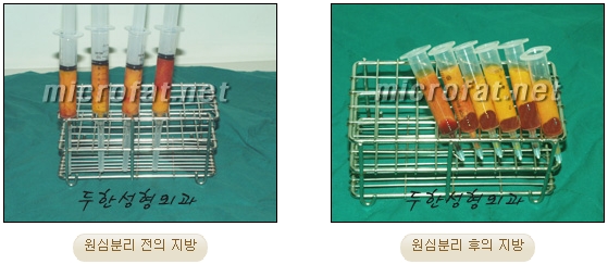 [두한성형외과 얼굴지방이식] - [측두부, 관자놀이] 관련 이미지 4